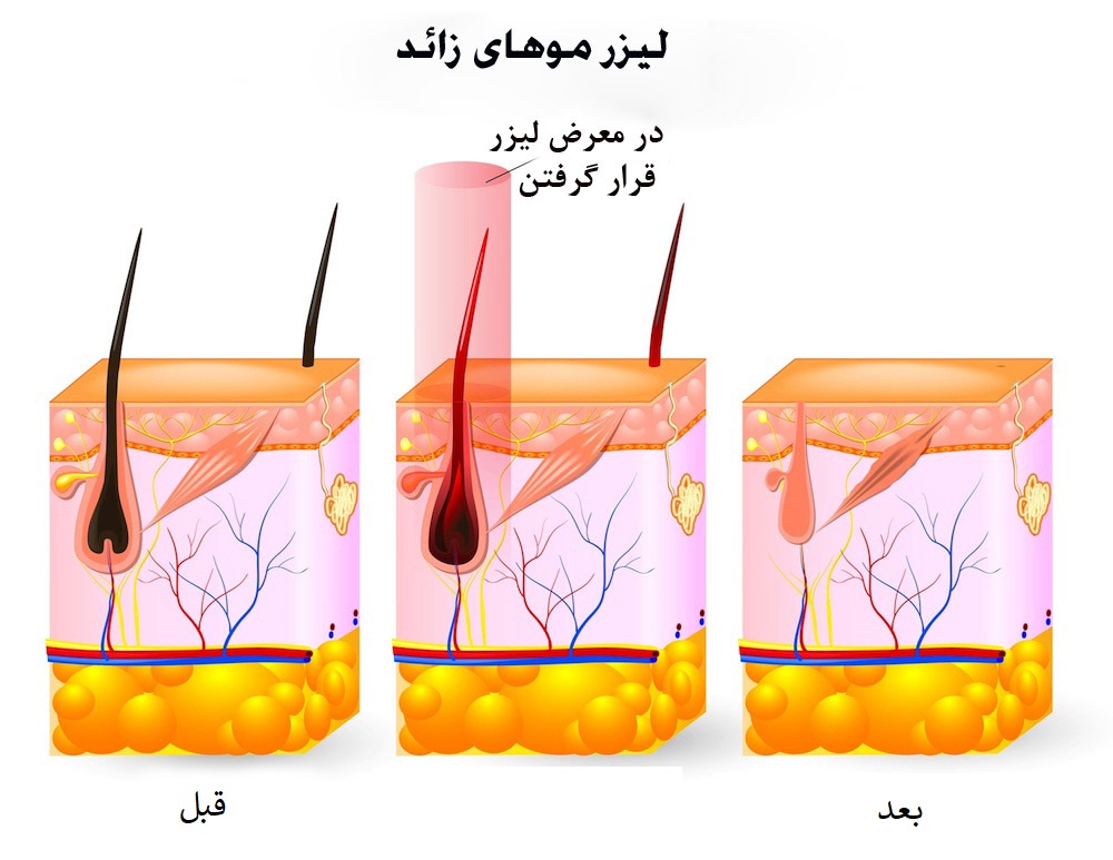 عملکرد لیزر موهای زائد