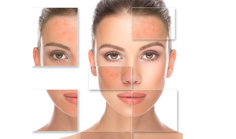 ipl laser for acne scars 1